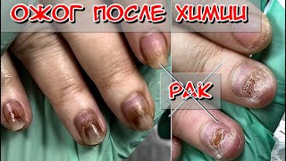 Nail burn after chemotherapy / Nails after cancer / Nails after chemistry