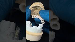 #implantdentistry #dentist #dentallaboratory #dentalcaddesign #dentalartistry #digitaldentistry