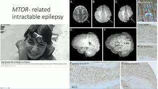 Pediatric Epilepsy Surgery: Translating Genomic Discoveries to Precision-Based Medicine
