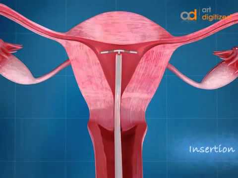 введение и удаление внутриматочной спирали