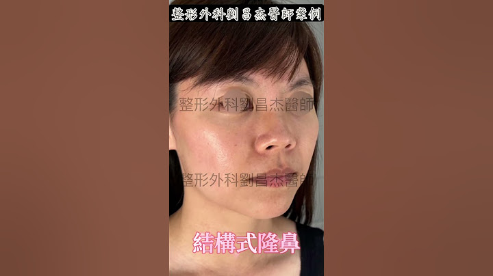 結構式隆鼻 x 無痕鼻翼  #隆鼻 #結構式隆鼻 #鼻整形#縮鼻翼 #隱痕縮鼻翼 #無痕鼻翼#rhinoplasty #NasalAlarReduction#劉昌杰醫師 #整形外科