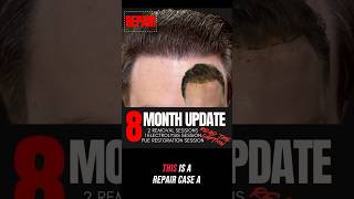 🛠️ From Repair to Remarkable FUE Transformation ✨