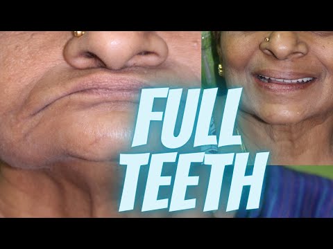 teeth-filling-treatment---from-no-teeth-to-functional-teeth-in-5-days