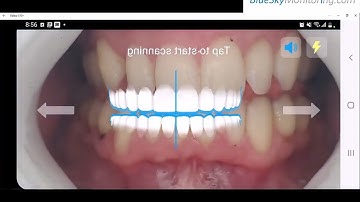 BlueSkyMonitoring.com: 2 Min Video- Remote Monitoring of Your Aligner Patients