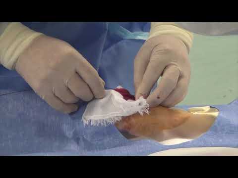 Distal Radial Artery Cannulation