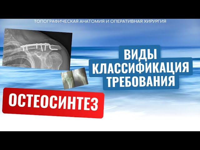 ОСТЕОСИНТЕЗ - Определение, Цели, Требования, Классификация (Топографическая Анатомия и Хирургия)