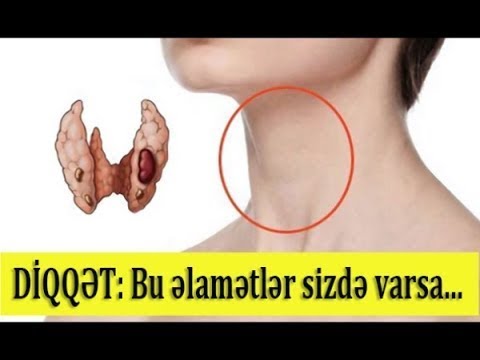 Video: Şəkərli diabet başgicəllənməyə səbəb ola bilərmi?