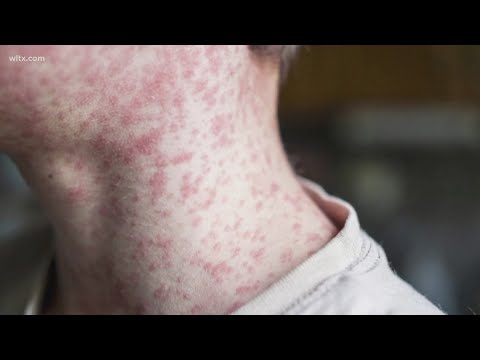 26 New Measles Cases In The Upstate Bringing The Total To 211 