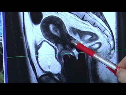 Video: Protonterapi För Prostatacancer: Fördelar, Risker Och Mer