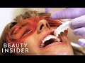 The Fastest Way Dentists Whiten Teeth | Beauty Explorers