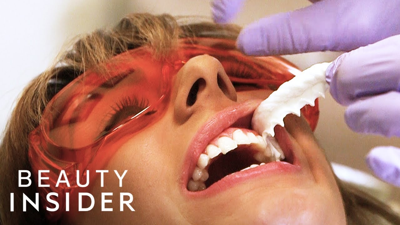 The Fastest Way Dentists Whiten Teeth