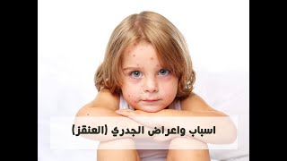 اسباب واعراض الجدري المائي ( العنقز )