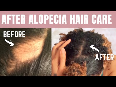 STOP YOUR HAIR FROM FALLING OUT AGAIN! After Alopecia Areata Hair Care Tips