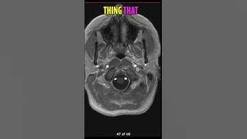 Brain Shrinkage & Black Holes  MS MRI Scan Explained