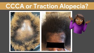 CCCA vs Traction Alopecia | What's the difference?