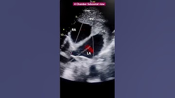 2D Echocardiography Subcostal View l #echo #shorts