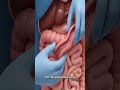 Ileocaecal TB: Surgical Consultant's Blueprint for UG/PG Med Students #doctor#anatomy#surgery#short