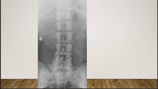 Short Case Disussion : Bertolotti yndrome (lumbosacral transitional vertebrae and low back pain)