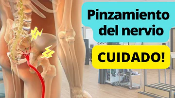 ¿Es lo mismo la ciática que un nervio pinzado?