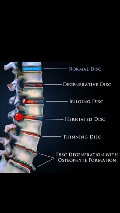 Spine Disc Degeneration