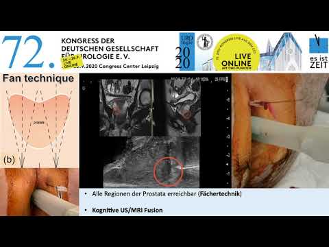 Video: Rektale Biopsie: Zweck, Verfahren Und Wiederherstellung