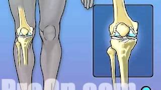 PreOp® Patient Education Knee Replacement Surgery 2