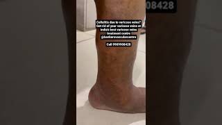 Cellulitis due to varicose veins? Get rid of your varicose veins at  bankers vascular centre screenshot 1
