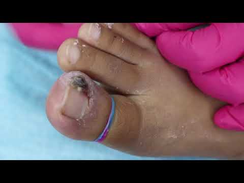 Ep_1565 Ingrown toenail removal 👣 นิ้วเท้าของสุดสวย 😝 (This clip is from Thailand)