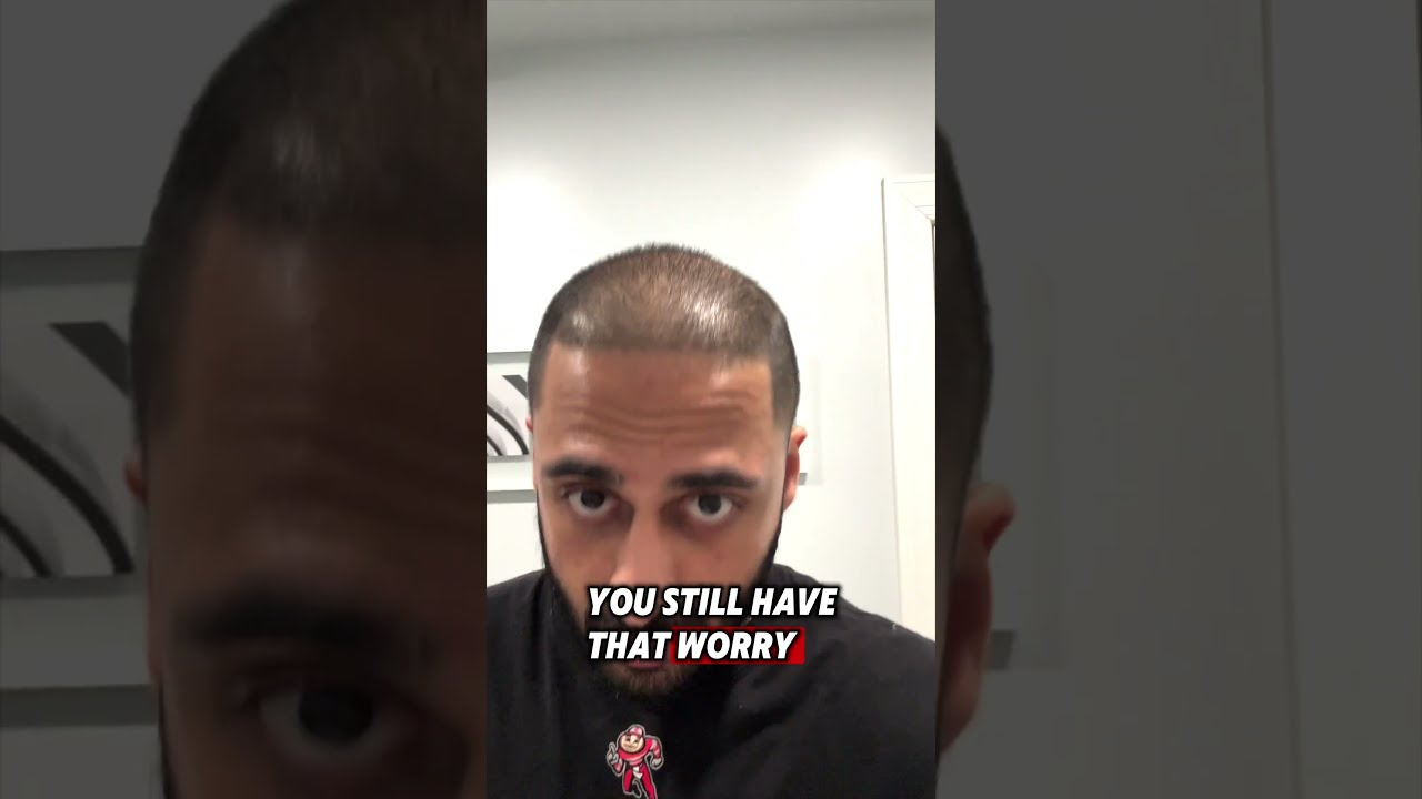 GOING BALD AFTER HAIR TRANSPLANT