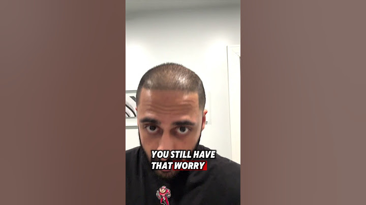 GOING BALD AFTER HAIR TRANSPLANT