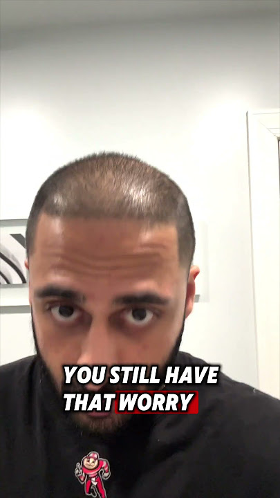 GOING BALD AFTER HAIR TRANSPLANT