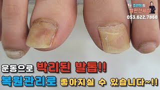 운동으로 변해버린 발톱!! #대구내성발톱 #대구무좀발톱 #문제성발 #fungal #toenails