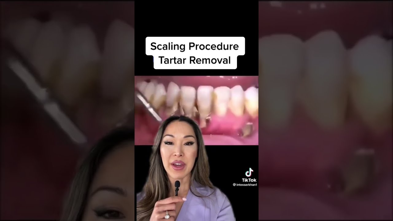 Scaling Procedure Tartar Removal Shorts