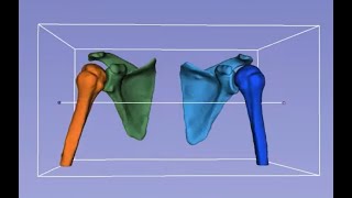 Bipolar Bone Defects in Shoulder Instability