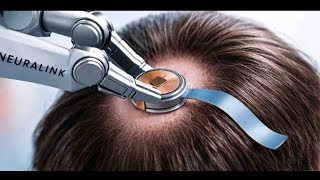 “Neuralink 2026: How 1,000 Brain Implants Could Change Human Thought Forever”