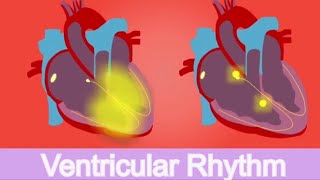Expert Insights: Understanding Ventricular and Idioventricular Rhythms