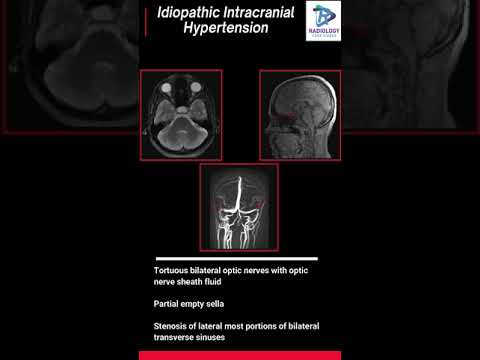 Idiopathic intracranial hypertension#Headache#MRI Headache protocol
