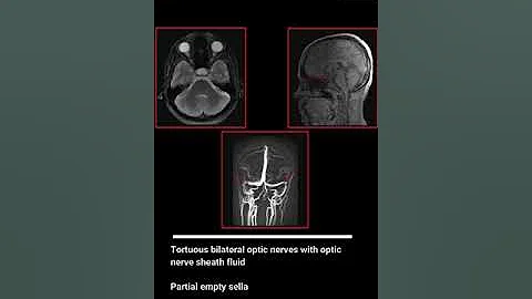 Idiopathic intracranial hypertension#Headache#MRI Headache protocol