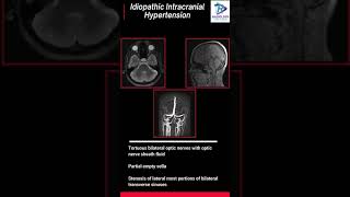 Download Lagu Idiopathic intracranial hypertension#Headache#MRI Headache protocol MP3