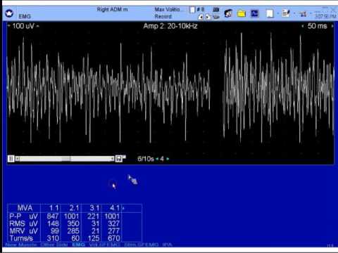 Video: Mutationsspektrum Av Autosomala Recessiva Muskeldystrofier I Lemmbandet I En Kohort Av 112 Iranska Patienter Och Rapportering Om En Möjlig Grundareeffekt