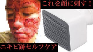 【エグい】140本の針を顔に刺してニキビ跡を治す男のナイトルーティーン Self Derma Vlog #2 【ダーマペン】