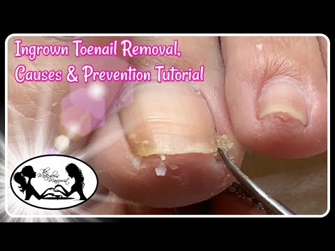 👣 Ingrown Toenail Removal Causes and Prevention Pedicure Tutorial 👣