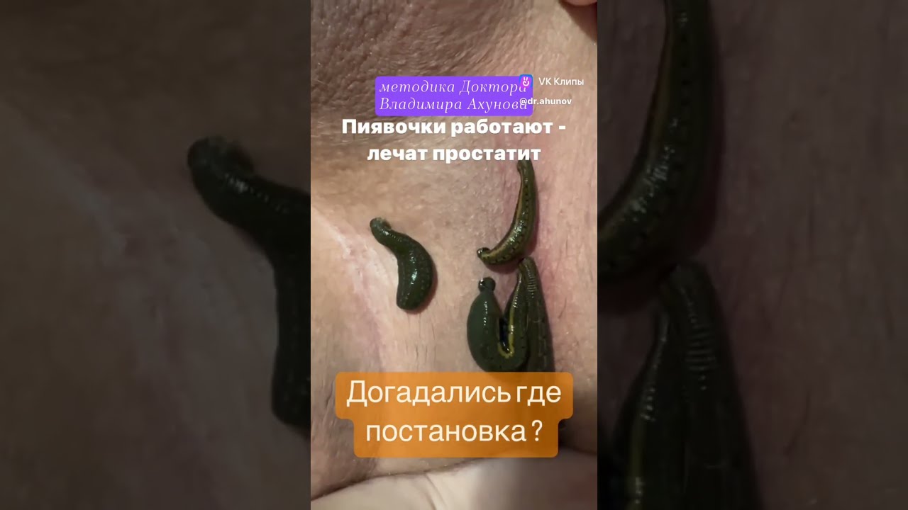Купить Книгу Лечение Пиявками