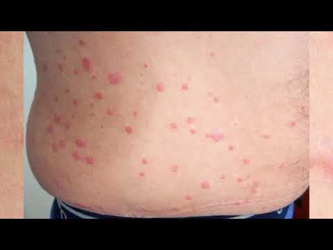 Guttate psoriasis: picture the initial stage, the symptoms in children and adults
