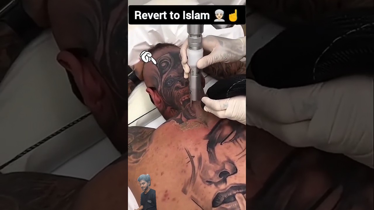 man Removing tatto after Reverting to islam