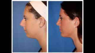 Trends In Facial Plastic Surgery Dr William Portuese 206-624-6200