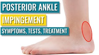 Posterior Ankle Impingement - Symptoms, Diagnosis, Treatment & Recovery Time