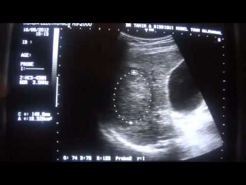 Automatisering Trend relais FOCAL LESION LIVER hypoechoic and hyperechoic - YouTube