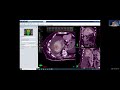Virtual SBRT and SRS Remote Training Session 6: SBRT/SRS Planning Demo