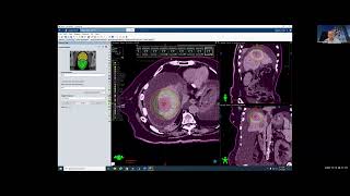 Virtual SBRT and SRS Remote Training Session 6: SBRT/SRS Planning Demo